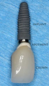 dental-implants-wiki