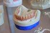Types Of Dental Prosthetics And Their Installation Stages
